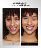 Red & Infrared LED Therapy for the Face