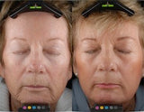 Image showing skin tightening, wrinkles and fine line reduction by DEKA DOT Laser Aesthetic Device. It is a great value laser purchase.