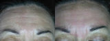 Image showing fine line reduction by DEKA DOT Laser Aesthetic Device. It is a great value laser purchase.
