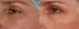 Image showing wrinkles and fine line reduction by DEKA DOT Laser Aesthetic Device. It is a great value laser purchase.