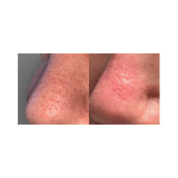 Before and after comparison of a person's reduction in pores. It is an ideal laser device urchase.