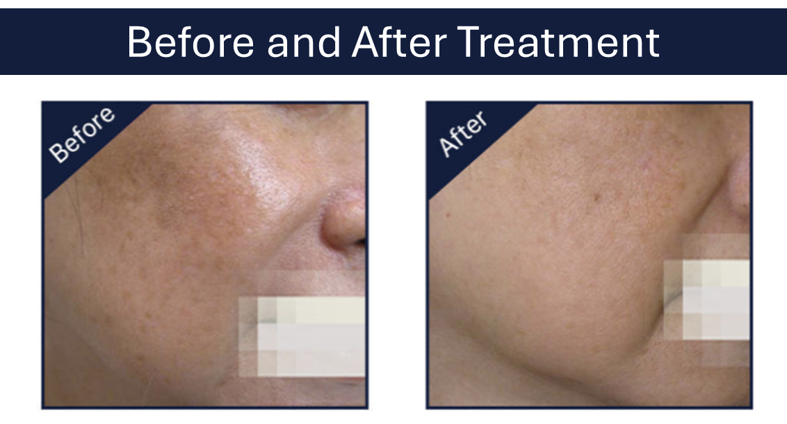 Image showing before and after treatment by this RF laser device.