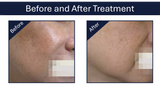 Image showing before and after treatment by this RF laser device.