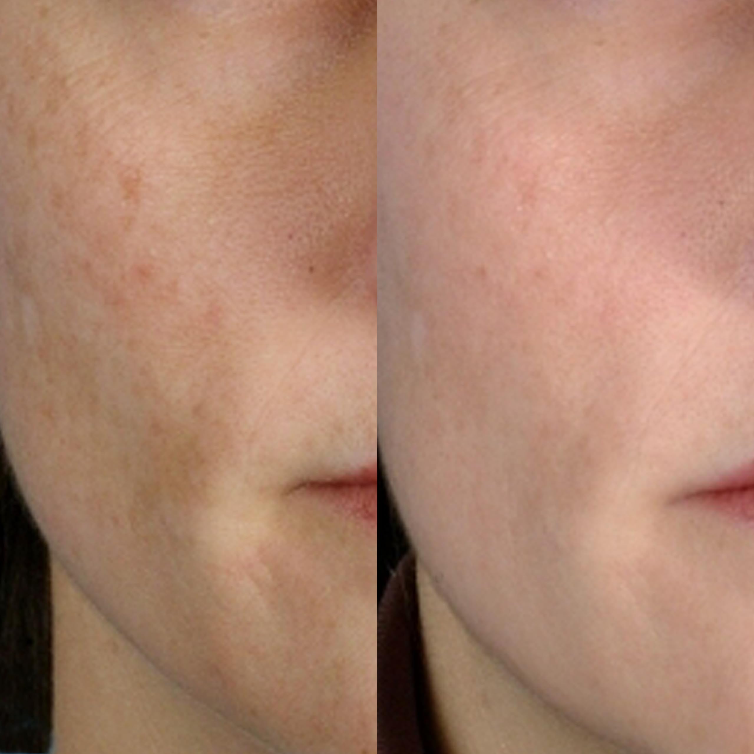 Image showing the before and after comparison of lady's face with visible reduction in scars and spots. It is an ideal device purchase.