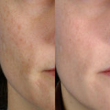 Image showing the before and after comparison of lady's face with visible reduction in scars and spots. It is an ideal device purchase.