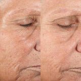 Image showing the before and after comparison of lady's face with visible reduction in fine lines and wrinkles. It is an ideal device purchase.
