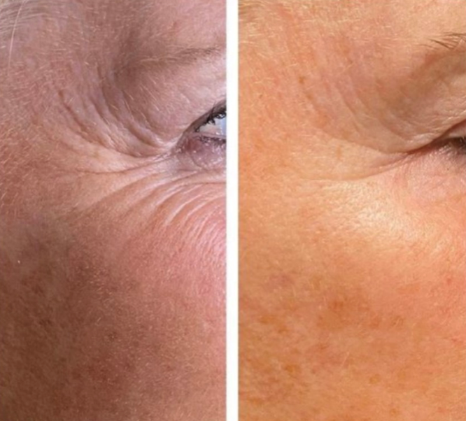A before and after skin comparison showing diminishing fine lines, wrinkles. It is a great plasma device purchase.