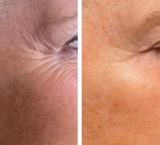A before and after skin comparison showing diminishing fine lines, wrinkles. It is a great plasma device purchase.