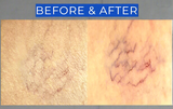 Before and after comparison of skin texture with visible differences. It is an ideal value LED device purchase.