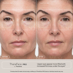 TheraFace PRO Multi-Tech. Facial Device (LED, Microcurrent & Massage)