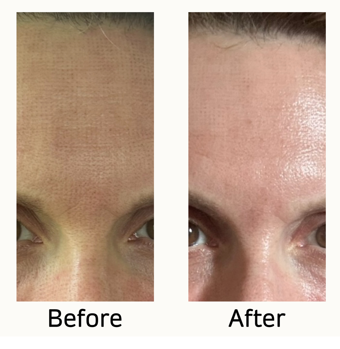 Before and after comparison of a person's face with visible skin texture differences from NewSurg CO2 UltraLight Laser