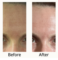 Before and after comparison of a person's face with visible skin texture differences from NewSurg CO2 UltraLight Laser