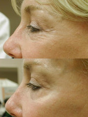 Image showing wrinkles and fine line reduction by DEKA DOT Laser Aesthetic Device. It is a great value laser purchase.