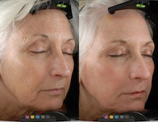 Image showing wrinkles and fine line reduction by DEKA DOT Laser Aesthetic Device. It is a great value laser purchase.