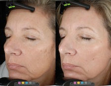 Image showing skin rejuvenation by DEKA DOT Laser Aesthetic Device. It is a great value laser purchase.