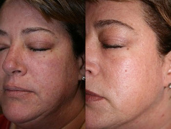 Image showing skin rejuvenation by DEKA DOT Laser Aesthetic Device. It is a great value laser purchase.