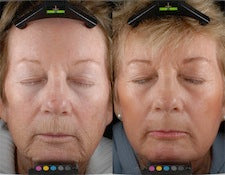 Image showing skin tightening, wrinkles and fine line reduction by DEKA DOT Laser Aesthetic Device. It is a great value laser purchase.