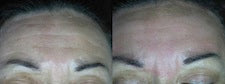 Image showing fine line reduction by DEKA DOT Laser Aesthetic Device. It is a great value laser purchase.