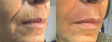 Image showing Skin Tightening by DEKA DOT Laser Aesthetic Device. It is a great value laser purchase.