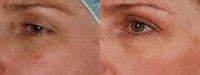 Image showing wrinkles and fine line reduction by DEKA DOT Laser Aesthetic Device. It is a great value laser purchase.