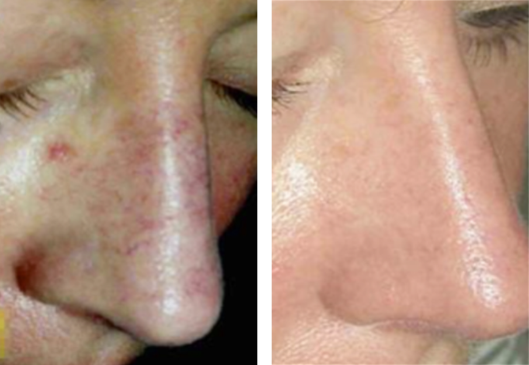Before and after comparison of a person's nose with visible skin conditions.