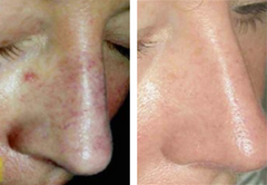 Before and after comparison of a person's nose with visible skin conditions.