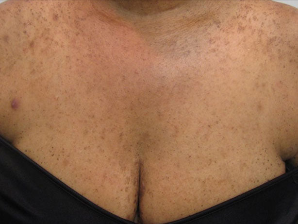 Image showing skin disease