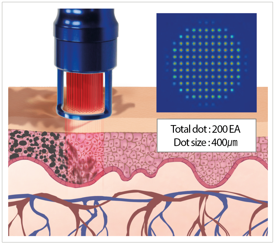 Noblex Long Pulsed Alexandrite Laser Dot Size depiction. It is a great value laser purchase.