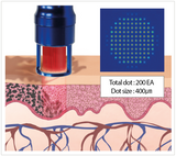 Noblex Long Pulsed Alexandrite Laser Dot Size depiction. It is a great value laser purchase.
