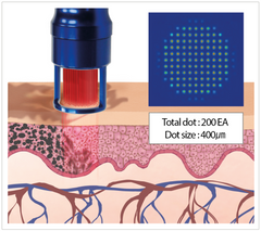 Noblex Long Pulsed Alexandrite Laser Dot Size depiction. It is a great value laser purchase.