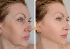Four Color LED Light Therapy Silicone Mask – App Controlled