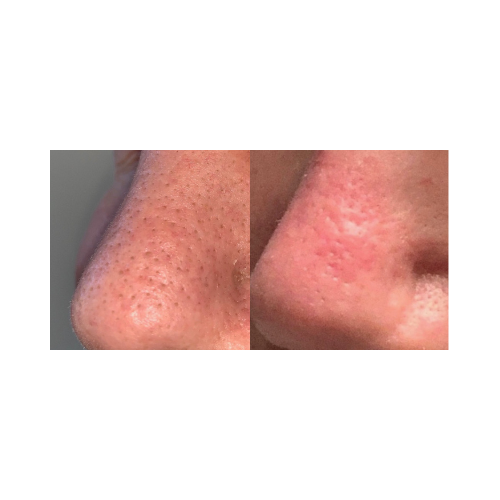 Before and after comparison of a person's reduction in pores. It is an ideal laser device urchase.