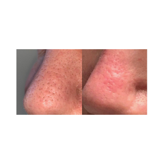 Before and after comparison of a person's reduction in pores. It is an ideal laser device urchase.