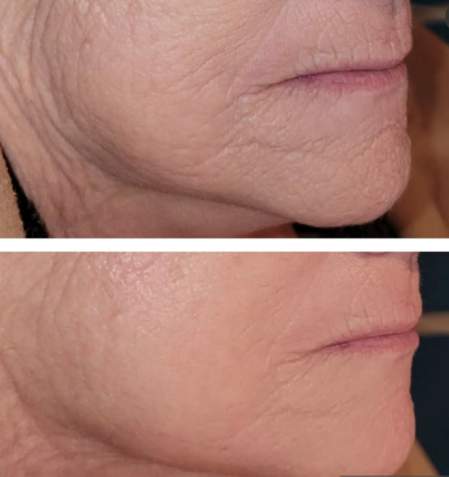 A before and after skin comparison showing diminishing fine lines, wrinkles and overall skin rejuvenation. It is a great plasma device purchase.