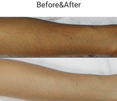 Before and after comparison of a person's arm with hair removal.