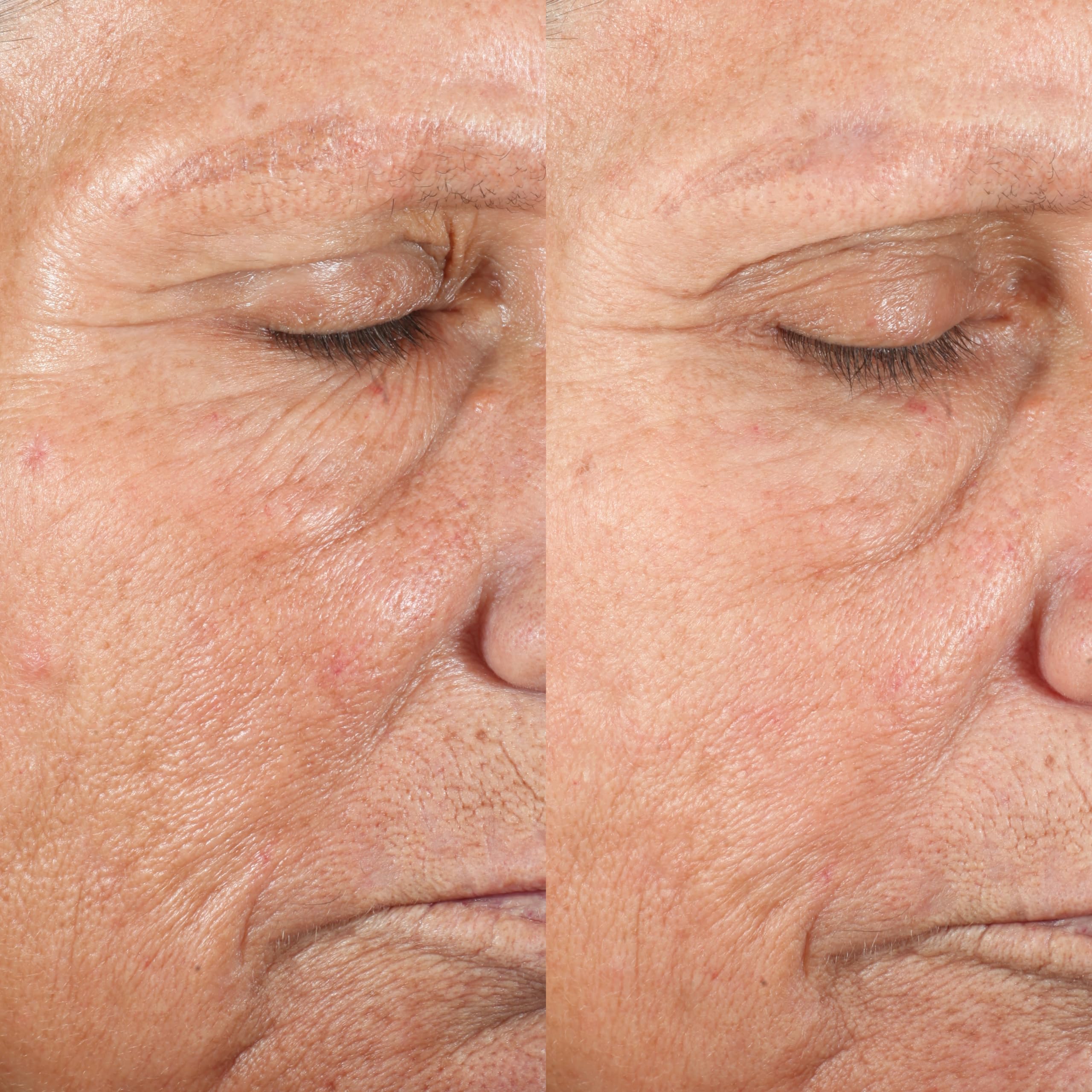 Image showing the before and after comparison of lady's face with visible reduction in fine lines and wrinkles. It is an ideal device purchase.