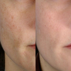 Image showing the before and after comparison of lady's face with visible reduction in scars and spots. It is an ideal device purchase.
