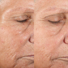 Image showing the before and after comparison of lady's face with visible reduction in fine lines and wrinkles. It is an ideal device purchase.