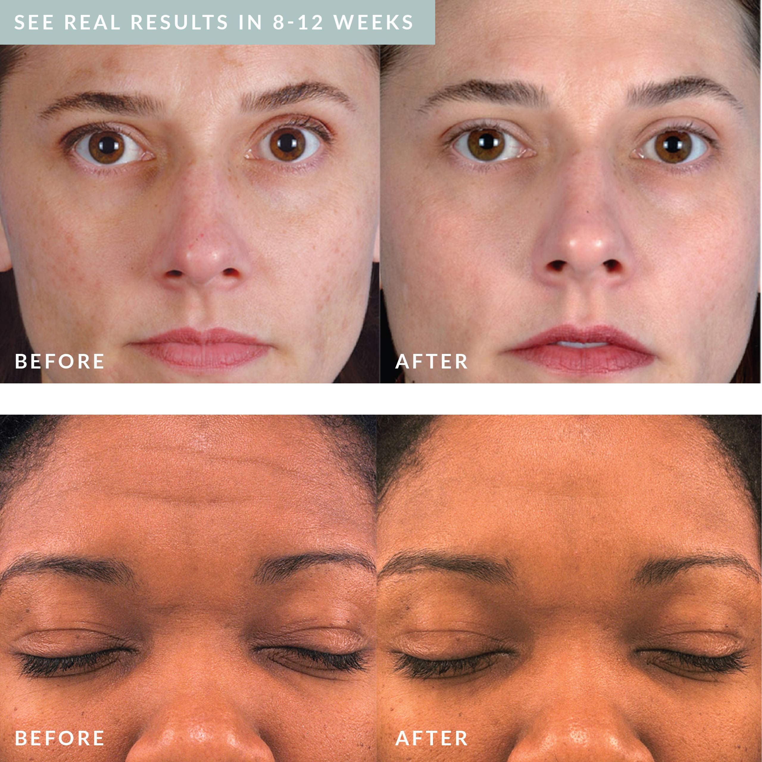 Image showing the Real results in 8-12 weeks with before and after comparison of lady's face with visible reduction in scars and spots, fine lines. It is an ideal device purchase.