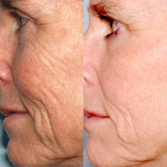Image showing the before and after comparison of lady's face with visible reduction in fine lines and wrinkles and face lift. It is an ideal device purchase.
