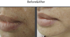 Before and after comparison of a person's lips with visible hair removal. 