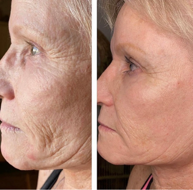A before and after skin comparison showing diminishing fine lines, wrinkles and overall skin rejuvenation. It is a great plasma device purchase.