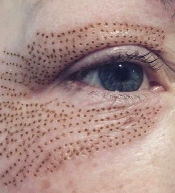Plasma treatment for wrinkles and fine lines reduction. It is an ideal device purchase.
