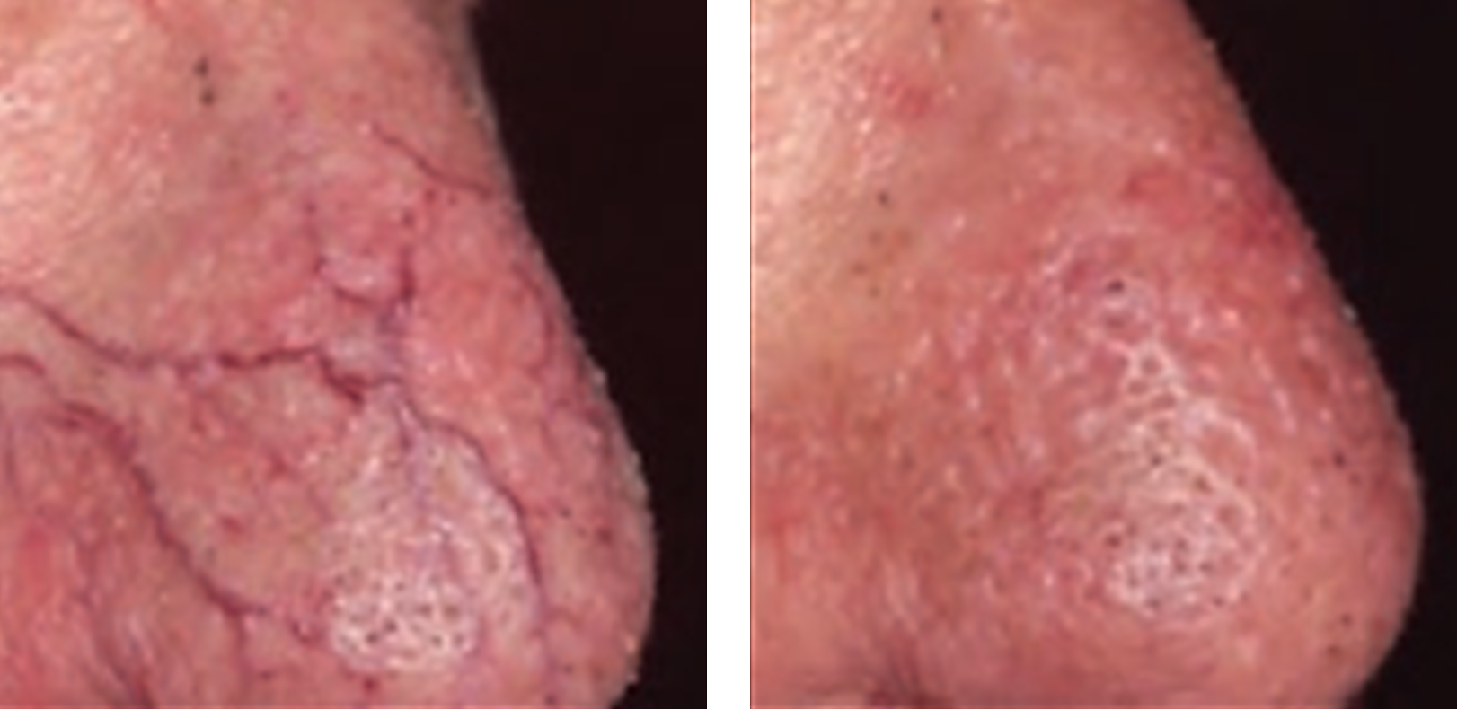 Close-up of a person's skin with visible texture and pores treated by DermaLight KTP Laser Device. It is a great value laser aesthetic purchase.