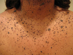 Image showing skin disease