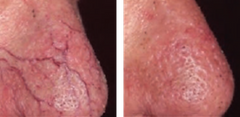 Close-up of a person's skin with visible texture and pores treated by DermaLight KTP Laser Device. It is a great value laser aesthetic purchase.
