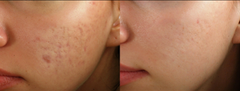Image showing before and after comparison of skin spots and scars treatment. It is an ideal value Microneedling device purchase.
