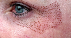 Plasma treatment for wrinkles and fine lines reduction.