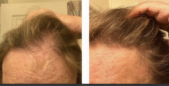 Before and after comparison of hair density on a person's head.