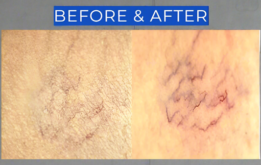 Before and after comparison of skin texture with visible differences. It is an ideal value LED device purchase.